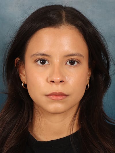 Rhinoplasty Before & After Gallery - Patient 61874293 - Image 6