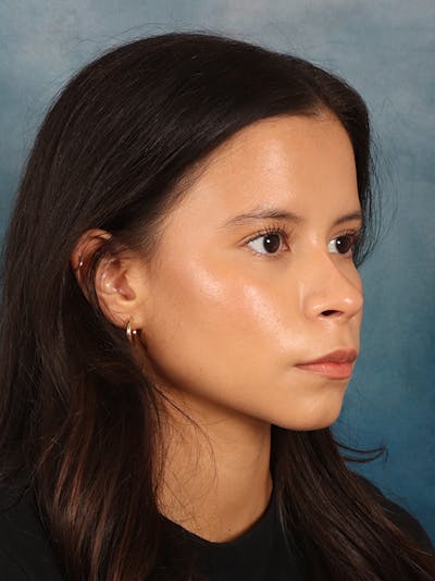 Rhinoplasty Before & After Gallery - Patient 61874293 - Image 8