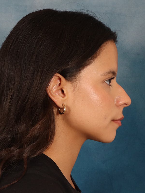 Rhinoplasty Before & After Gallery - Patient 61874293 - Image 9
