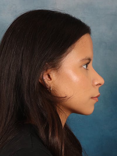 Rhinoplasty Before & After Gallery - Patient 61874293 - Image 10