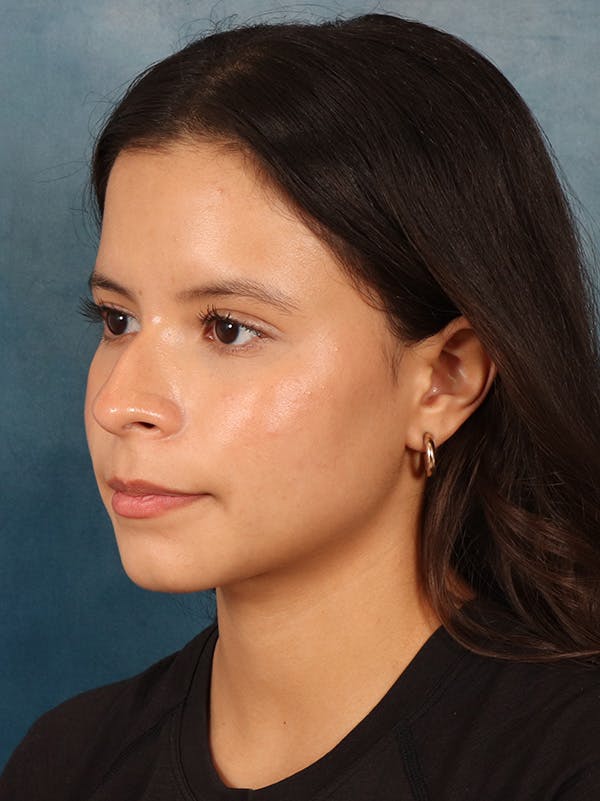 Rhinoplasty Before & After Gallery - Patient 61874293 - Image 3