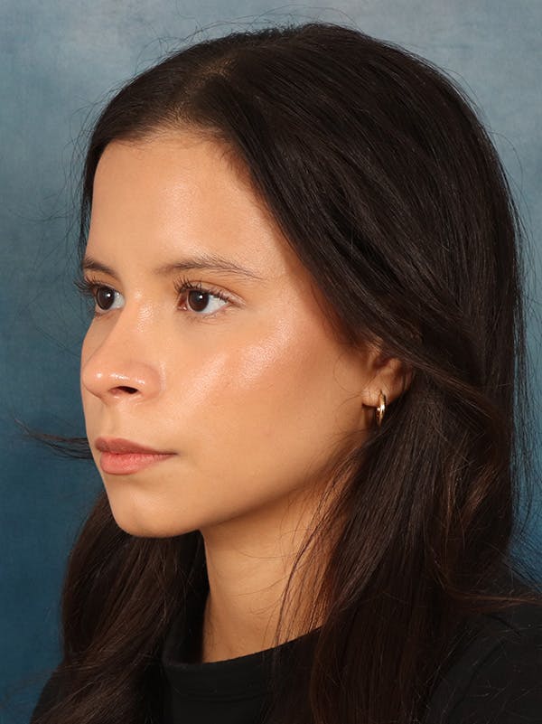 Rhinoplasty Before & After Gallery - Patient 61874293 - Image 4