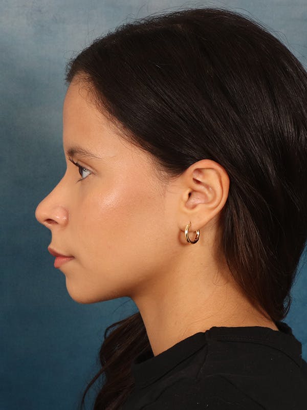 Rhinoplasty Before & After Gallery - Patient 61874293 - Image 2
