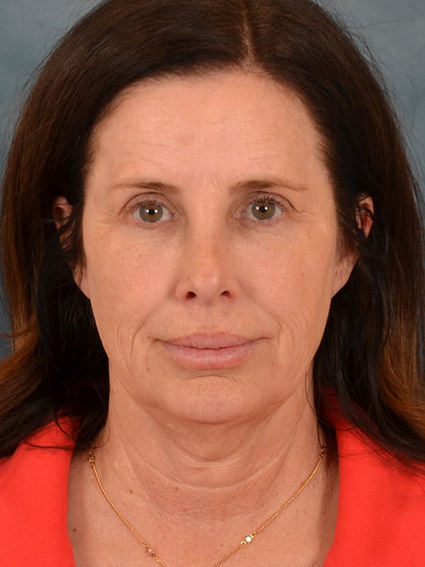 Laser Skin Resurfacing Before & After Gallery - Patient 509862 - Image 1