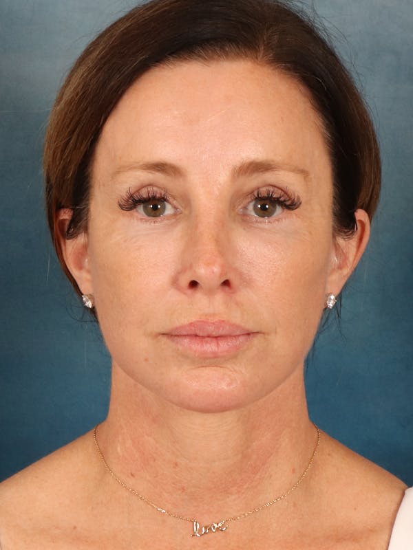 Laser Skin Resurfacing Before & After Gallery - Patient 509862 - Image 2