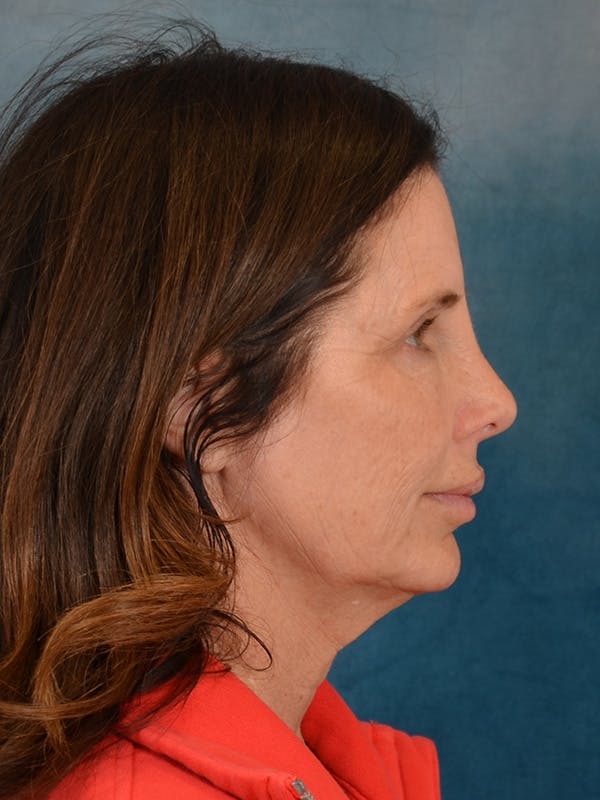 Laser Skin Resurfacing Before & After Gallery - Patient 509862 - Image 7