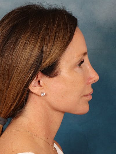 Laser Skin Resurfacing Before & After Gallery - Patient 509862 - Image 8