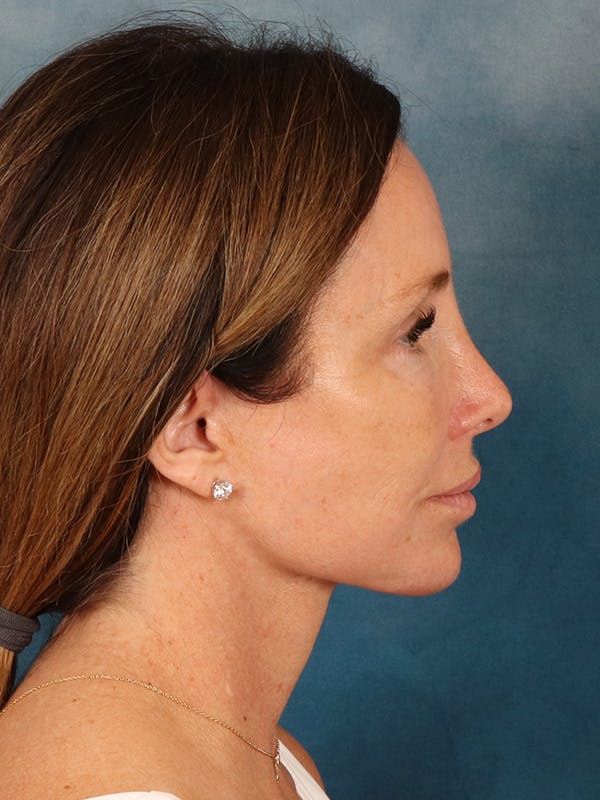 Laser Skin Resurfacing Before & After Gallery - Patient 509862 - Image 8