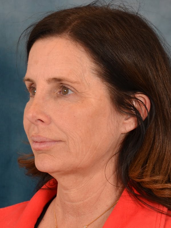 Laser Skin Resurfacing Before & After Gallery - Patient 509862 - Image 3