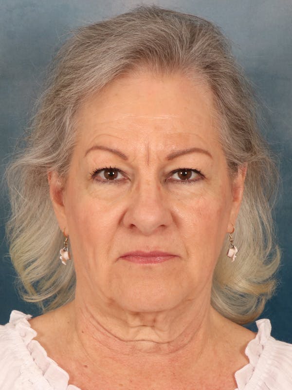 Deep Neck Lift Before & After Gallery - Patient 379097 - Image 1