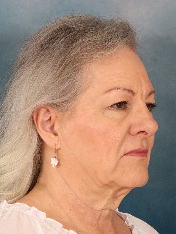 Deep Neck Lift Before & After Gallery - Patient 379097 - Image 7