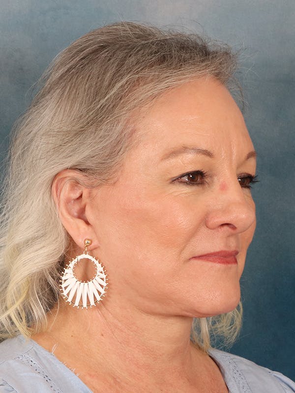 Deep Neck Lift Before & After Gallery - Patient 379097 - Image 8