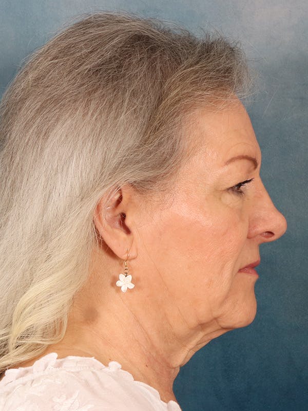 Deep Neck Lift Before & After Gallery - Patient 379097 - Image 9