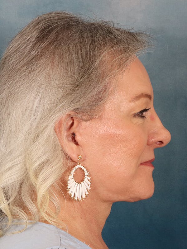 Deep Neck Lift Before & After Gallery - Patient 379097 - Image 10