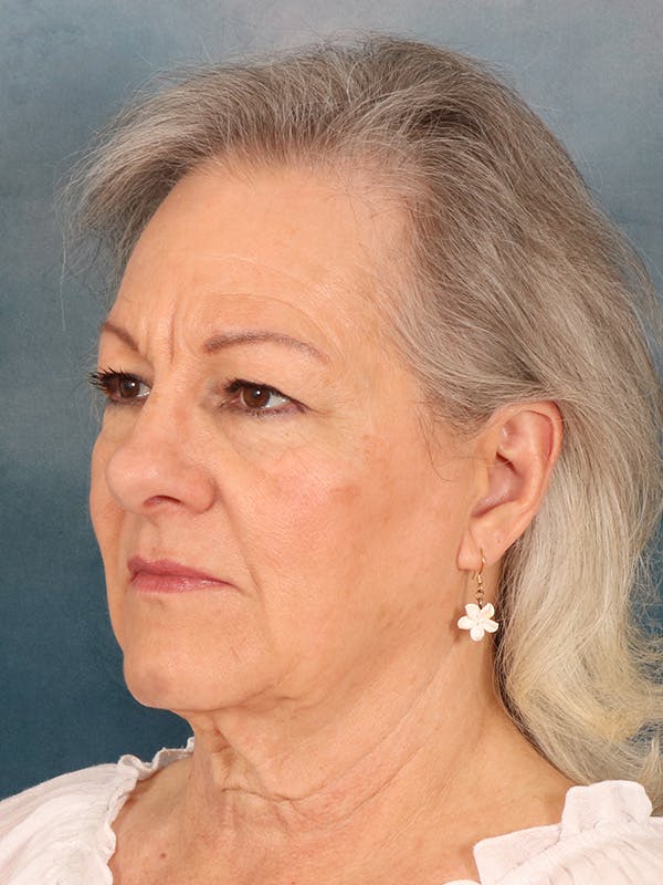 Deep Neck Lift Before & After Gallery - Patient 379097 - Image 3