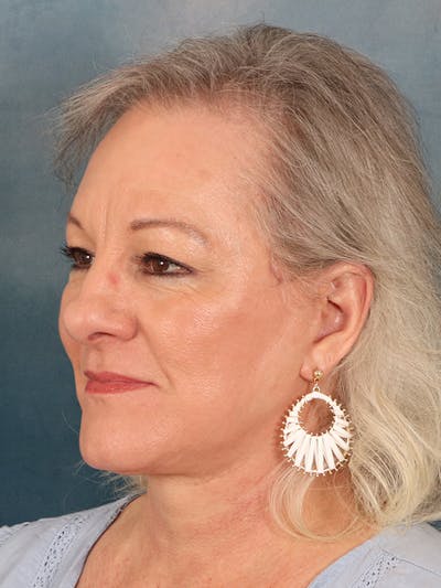 Deep Neck Lift Before & After Gallery - Patient 379097 - Image 4