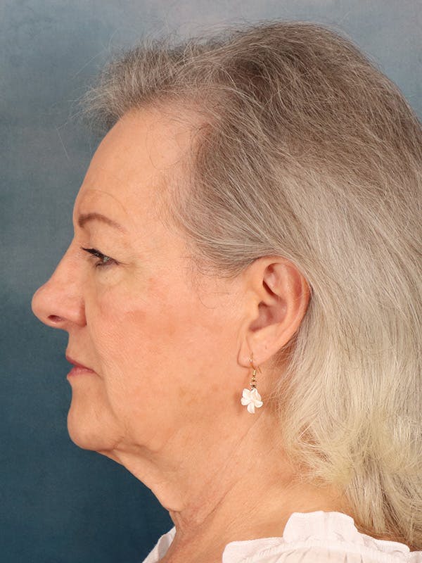 Deep Neck Lift Before & After Gallery - Patient 379097 - Image 5