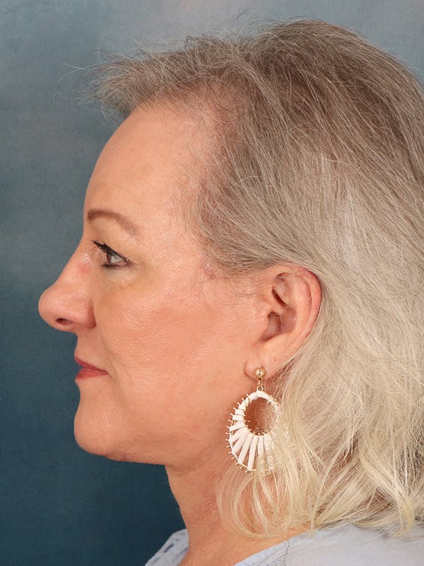 Deep Neck Lift Before & After Gallery - Patient 379097 - Image 6
