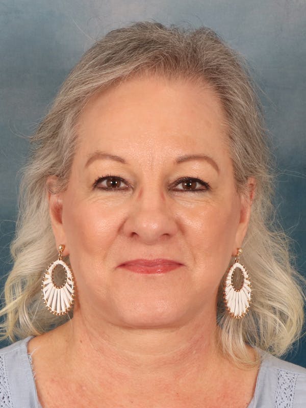 Deep Neck Lift Before & After Gallery - Patient 379097 - Image 2