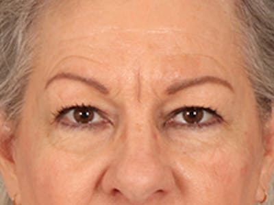 Eyelid Lift Before & After Gallery - Patient 225496 - Image 1