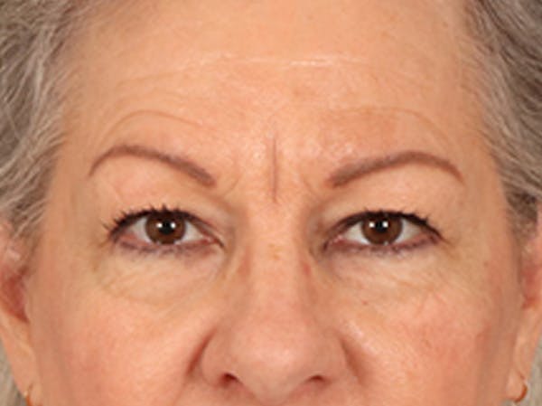 Eyelid Lift Before & After Gallery - Patient 225496 - Image 1