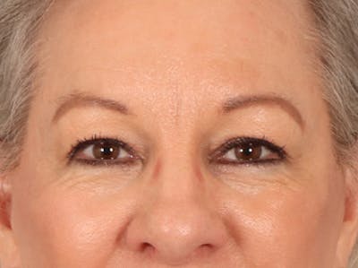 Eyelid Lift Before & After Gallery - Patient 225496 - Image 2
