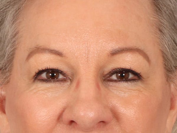 Eyelid Lift Before & After Gallery - Patient 225496 - Image 2