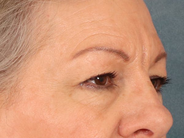 Eyelid Lift Before & After Gallery - Patient 225496 - Image 3