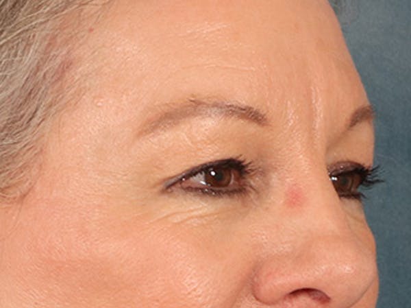 Eyelid Lift Before & After Gallery - Patient 225496 - Image 4