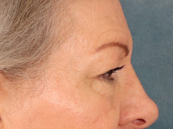 Eyelid Lift Before & After Gallery - Patient 225496 - Image 5