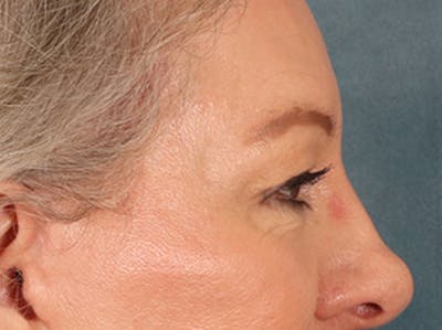 Eyelid Lift Before & After Gallery - Patient 225496 - Image 6