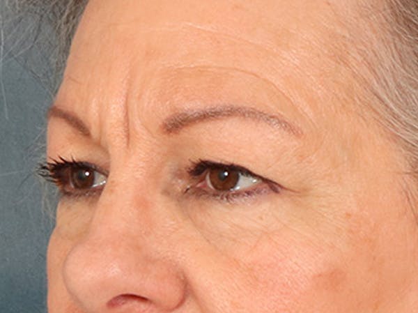 Eyelid Lift Before & After Gallery - Patient 225496 - Image 7