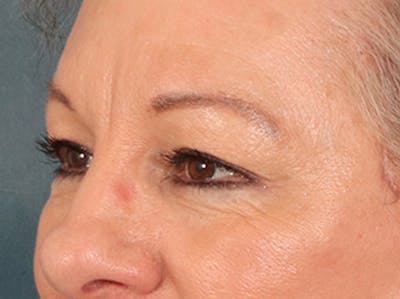 Eyelid Lift Before & After Gallery - Patient 225496 - Image 8