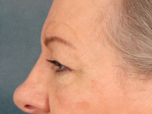 Eyelid Lift Before & After Gallery - Patient 225496 - Image 9