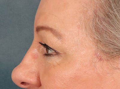 Eyelid Lift Before & After Gallery - Patient 225496 - Image 10