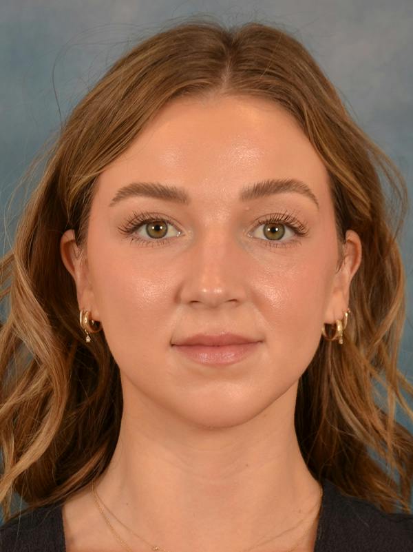Rhinoplasty Before & After Gallery - Patient 419614 - Image 3