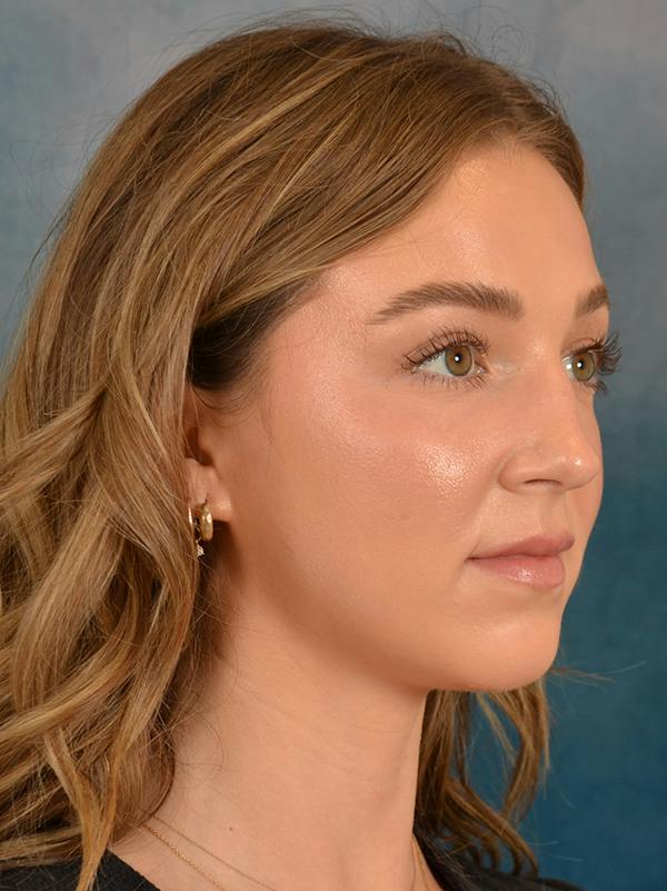 Rhinoplasty Before & After Gallery - Patient 419614 - Image 7