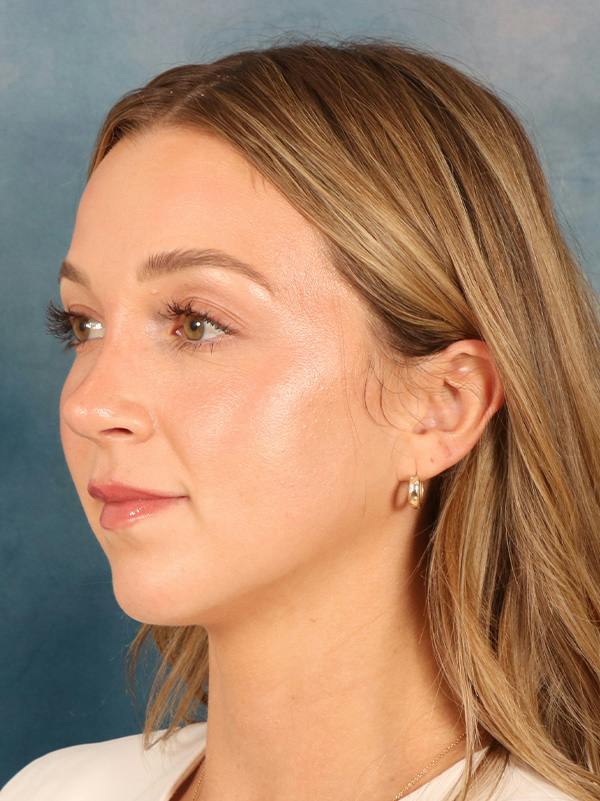 Rhinoplasty Before & After Gallery - Patient 419614 - Image 6