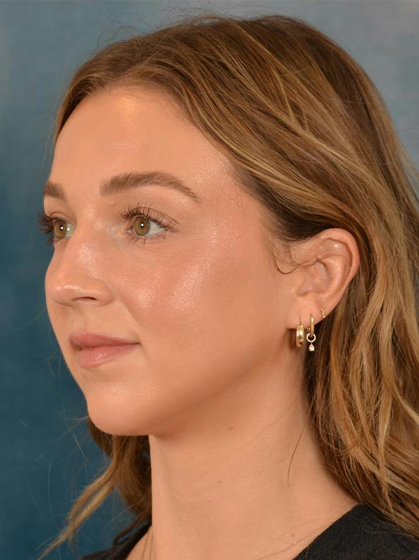 Rhinoplasty Before & After Gallery - Patient 419614 - Image 5