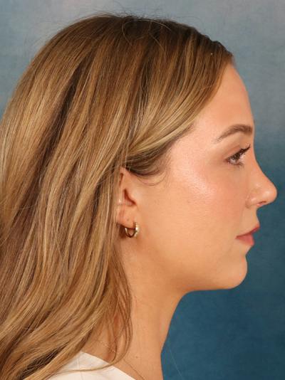Rhinoplasty Before & After Gallery - Patient 419614 - Image 10