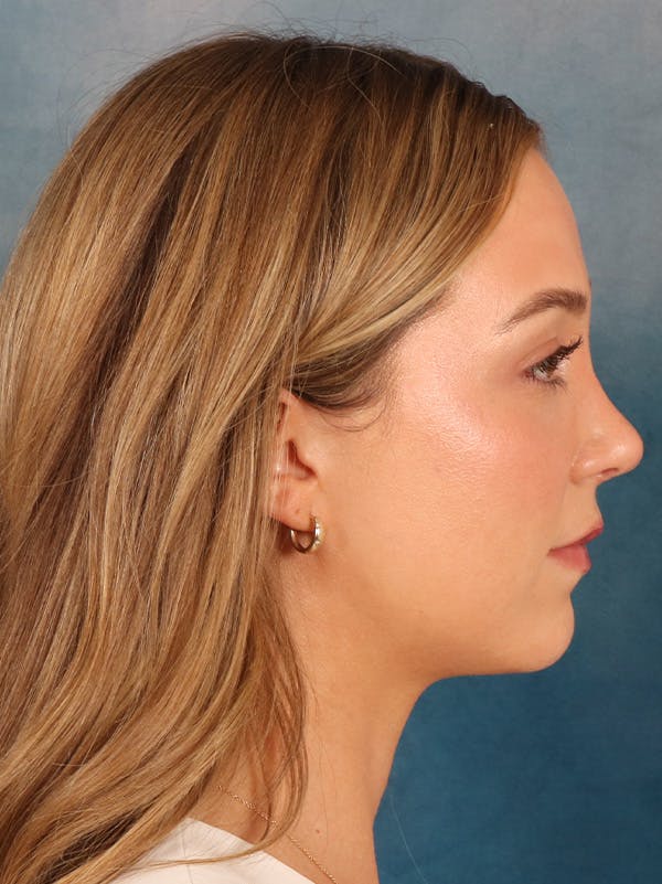 Rhinoplasty Before & After Gallery - Patient 419614 - Image 10