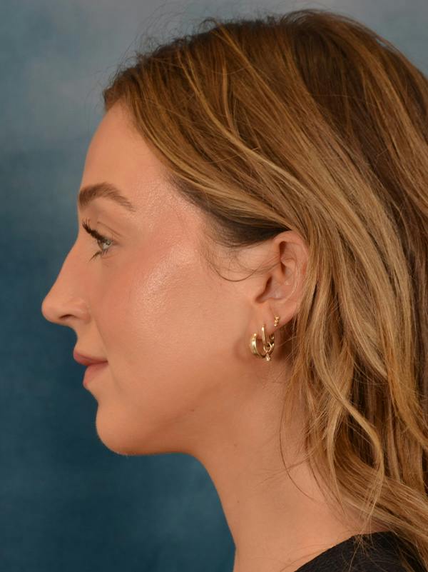Rhinoplasty Before & After Gallery - Patient 419614 - Image 1
