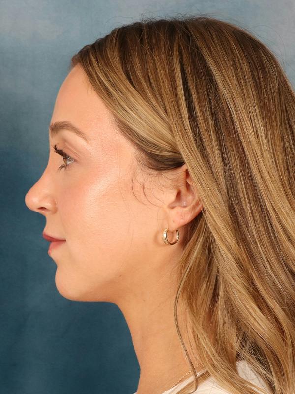 Rhinoplasty Before & After Gallery - Patient 419614 - Image 2