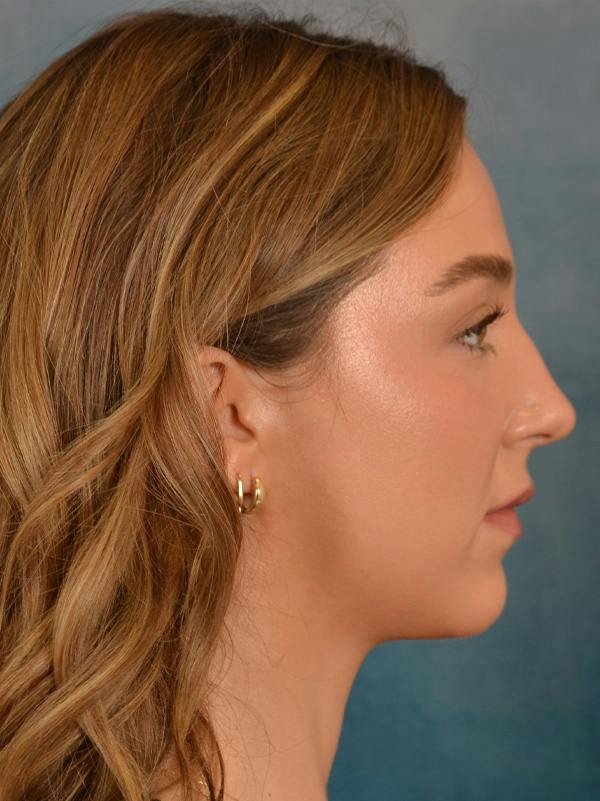 Rhinoplasty Before & After Gallery - Patient 419614 - Image 9