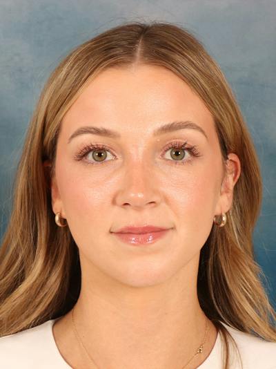 Rhinoplasty Before & After Gallery - Patient 419614 - Image 4