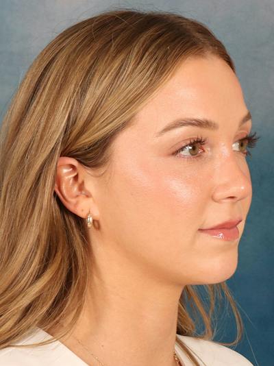 Rhinoplasty Before & After Gallery - Patient 419614 - Image 8