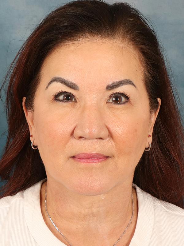 Deep Plane Facelift Before & After Gallery - Patient 366698 - Image 4
