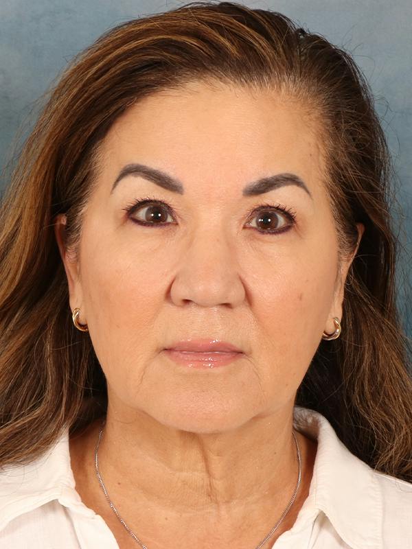 Deep Plane Facelift Before & After Gallery - Patient 366698 - Image 3