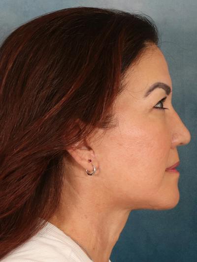 Deep Plane Facelift Before & After Gallery - Patient 366698 - Image 6