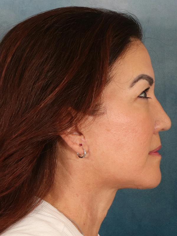 Deep Plane Facelift Before & After Gallery - Patient 366698 - Image 6